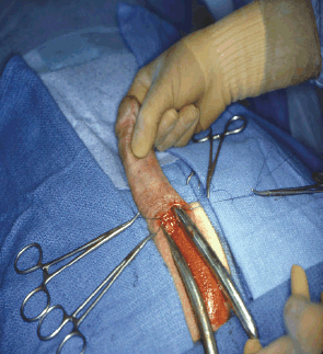 Penis Inplant 91